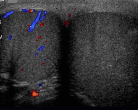 partial torsion testes|partial testicular torsion ultrasound.